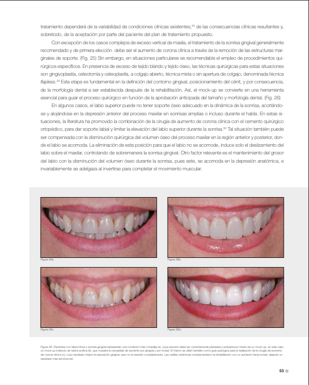 Labios finos y sonrisa gingival